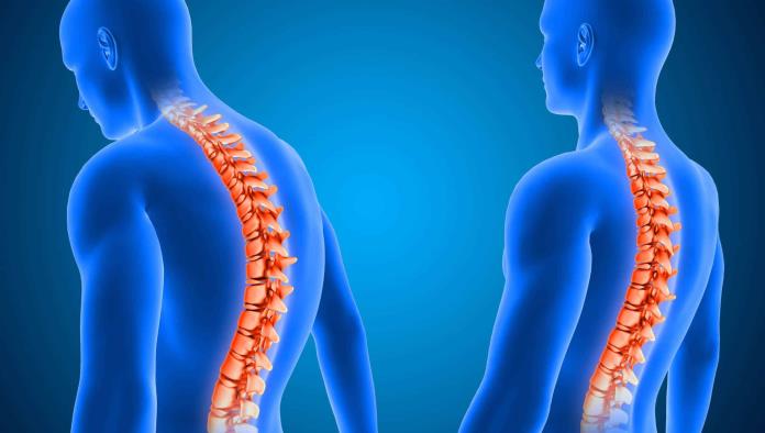 IMSS: Recomienda traumatólogo tomar acciones preventivas para cuidado de columna vertebral