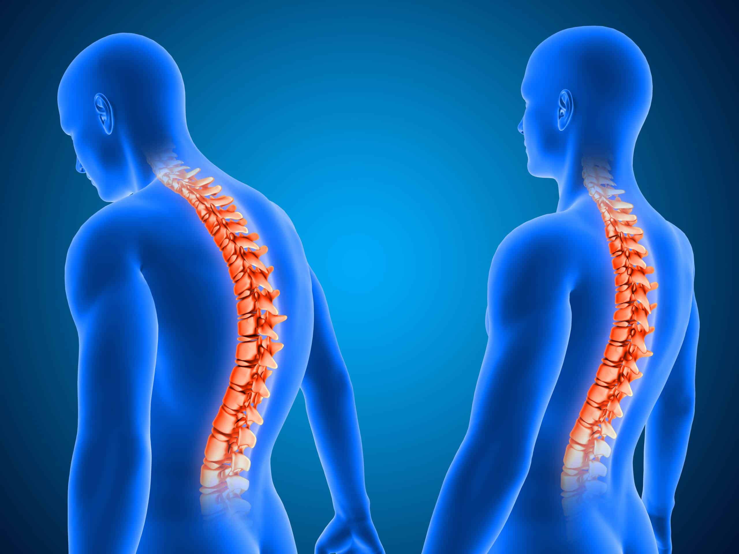 IMSS: Recomienda traumatólogo tomar acciones preventivas para cuidado de columna vertebral