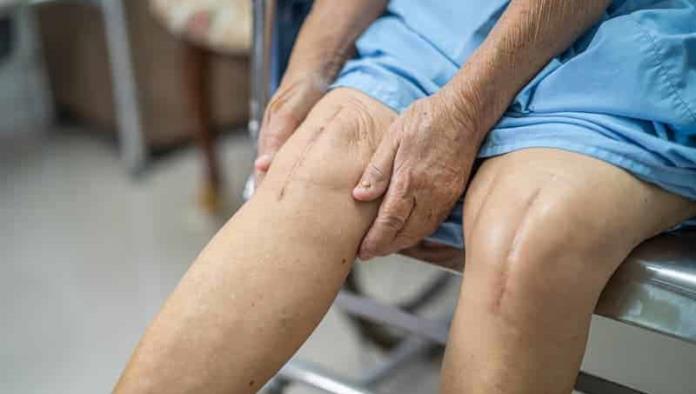 Tendrá hospital general jornada de cirugías de prótesis de rodilla