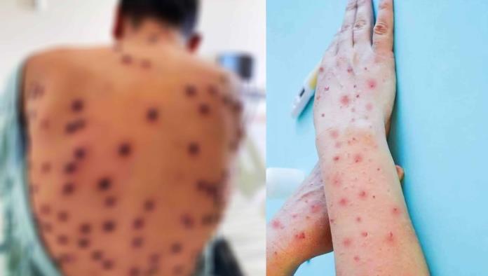 Emiten Alerta Sanitaria por Viruela del Mono en Piedras Negras