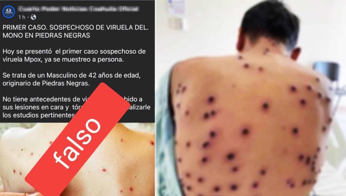 LO DESMIENTEN: Circula en redes información FALSA sobre VIRUELA DEL MONO en Piedras Negras