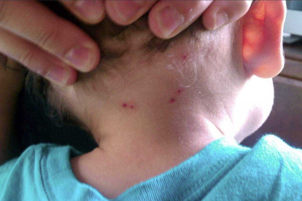 Señalan que los síntomas de la rickettsia son muy similares a los de cualquier infección.