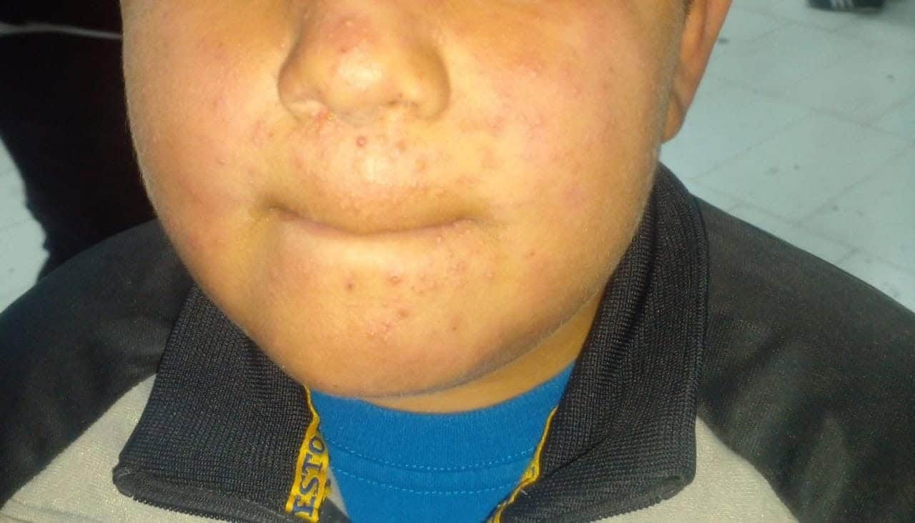 Madres de familia denuncian posible brote de dengue en primaria Jose María Morelos y Pavón.