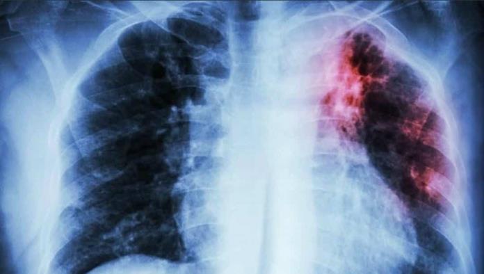 Diciembre Detona Casos de Tuberculosis en la Comunidad