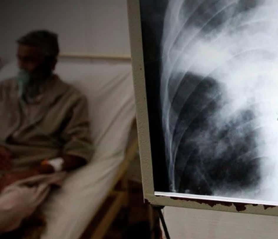 Diciembre Detona Casos de Tuberculosis en la Comunidad