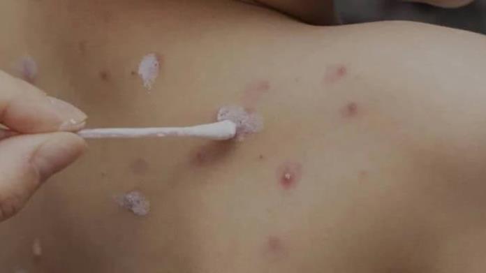 Incremento de Casos Sospechosos de Varicela en Piedras Negras Afecta a Cuatro Escuelas Incremento de Casos Sospechosos de Varicela en Piedras Negras Afecta a Cuatro Escuelas