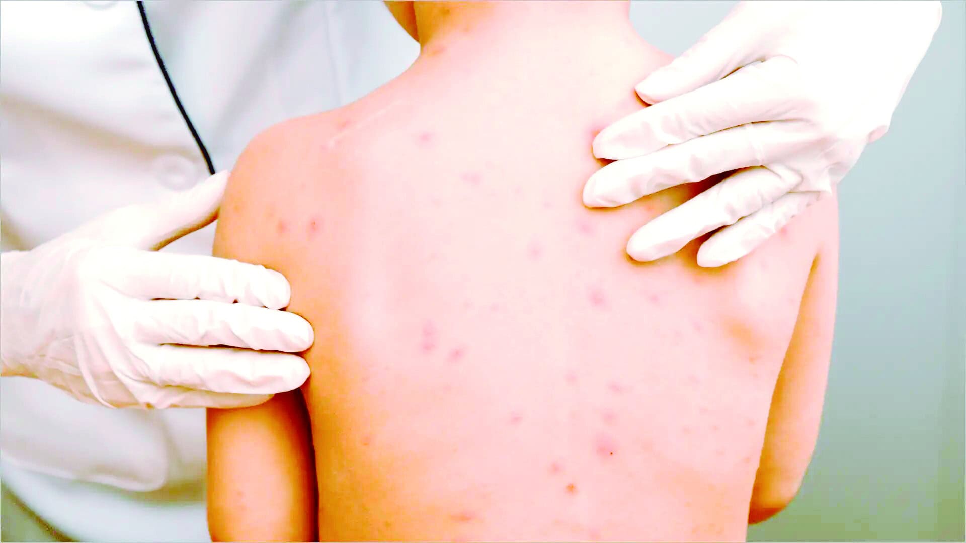 Descartan alerta en casos de varicela