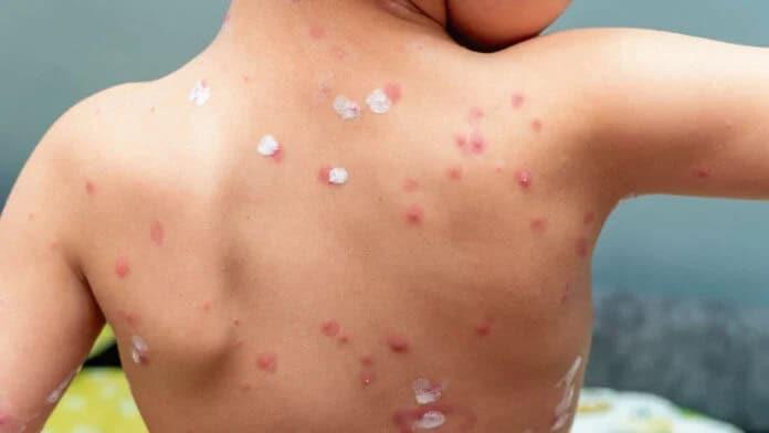 Detectan casos de varicela en escuelas de Piedras Negras