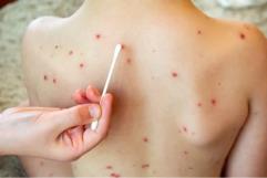 Activan ALERTA SANITARIA: Detectan seis casos de sarampión en Piedras Negras