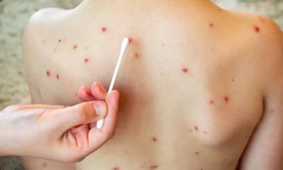 Activan ALERTA SANITARIA: Detectan seis casos de sarampión en Piedras Negras