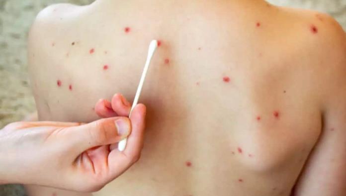 Activan ALERTA SANITARIA: Detectan seis casos de sarampión en Piedras Negras