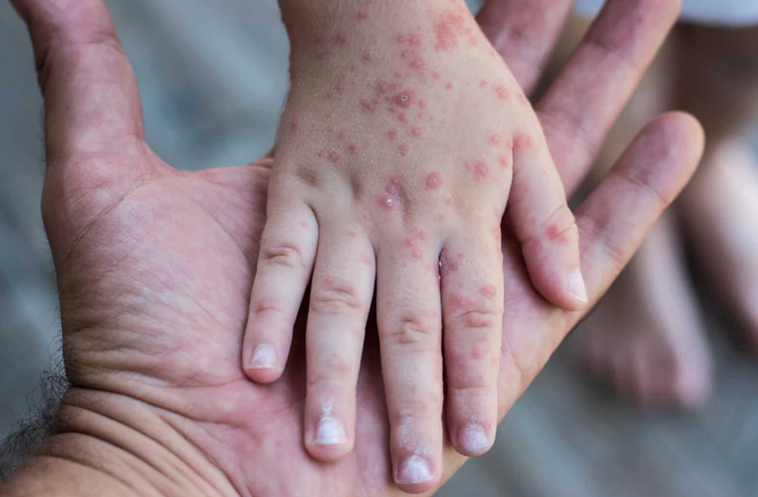 Descartan Brote de Sarampión en Escuelas de Piedras Negras
