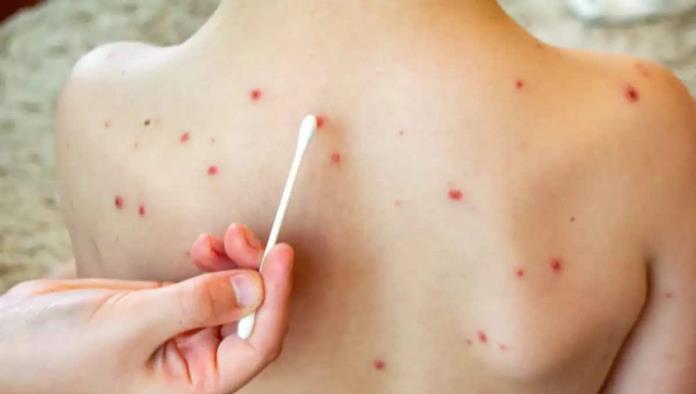 Descartan nuevos casos de sarampión en Piedras Negras