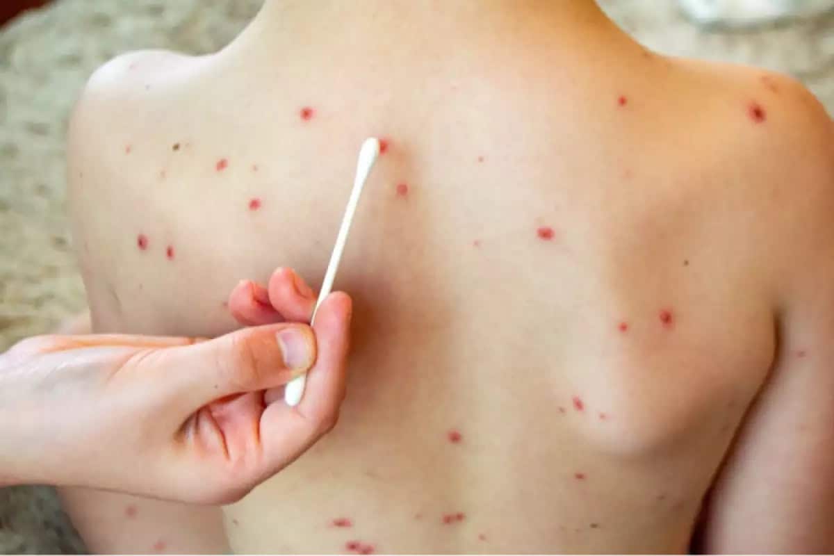 Descartan nuevos casos de sarampión en Piedras Negras