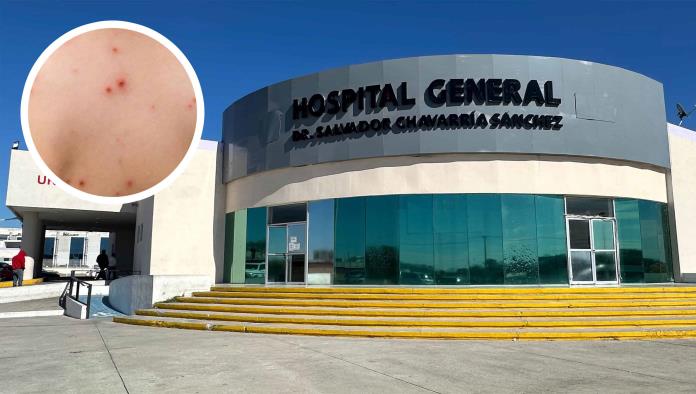 Confirman Brote de Sarampión en Piedras Negras