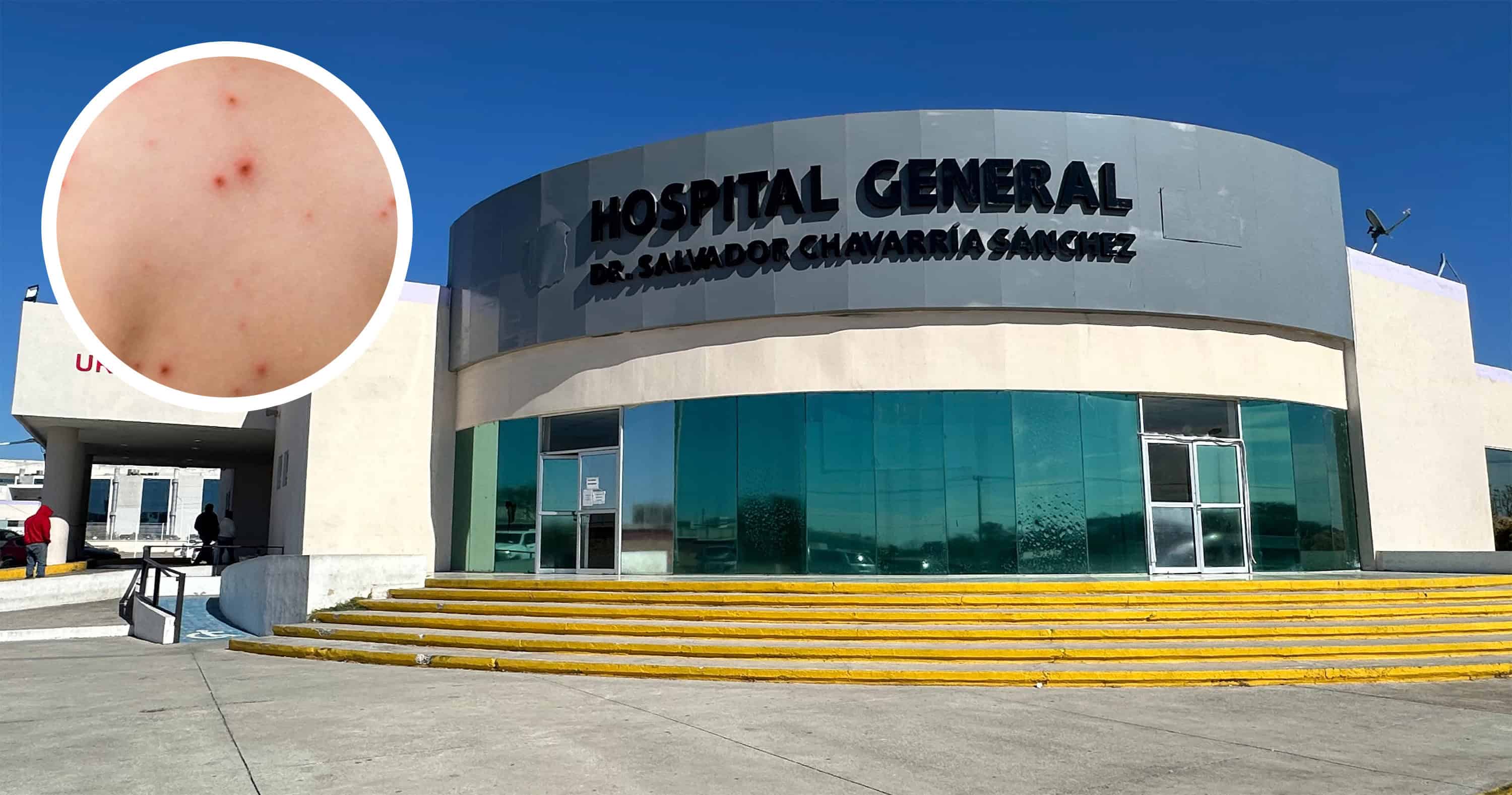 Confirman Brote de Sarampión en Piedras Negras