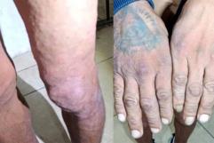 Descartan Caso de Sarampión en el Centro de Detención de Piedras Negras