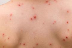 Confirman tres nuevos casos de sarampión en la región norte de Coahuila