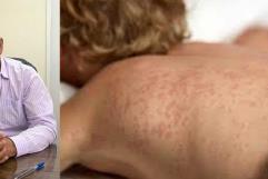 Acuña sin casos de sarampión pese a brotes en Texas