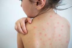 Coahuila confirma 47 casos de sarampión, tercer estado con más contagios en México