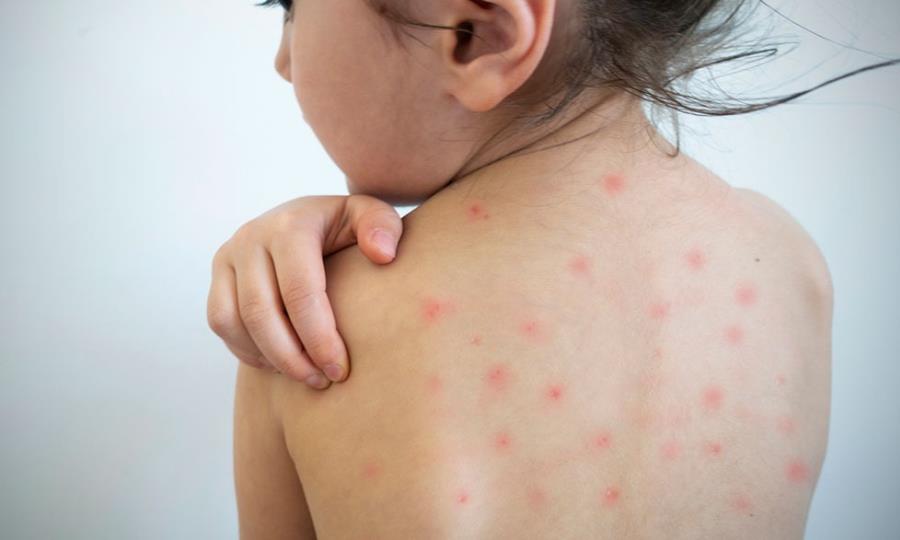 Coahuila confirma 47 casos de sarampión, tercer estado con más contagios en México