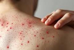 Alerta por casos de sarampión en América