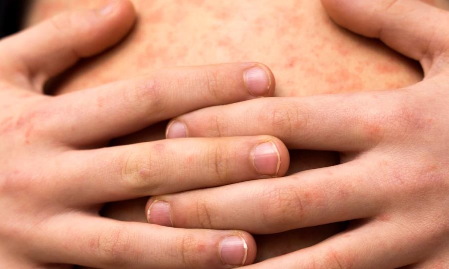 Alerta por Sarampión en México: Inicia Vacunación Masiva