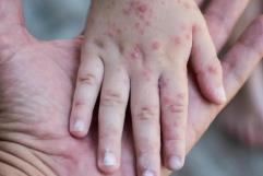 Investigan posible brote de virus coxsackie en colegio de Saltillo