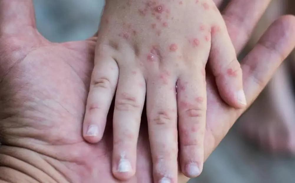 Investigan posible brote de virus coxsackie en colegio de Saltillo