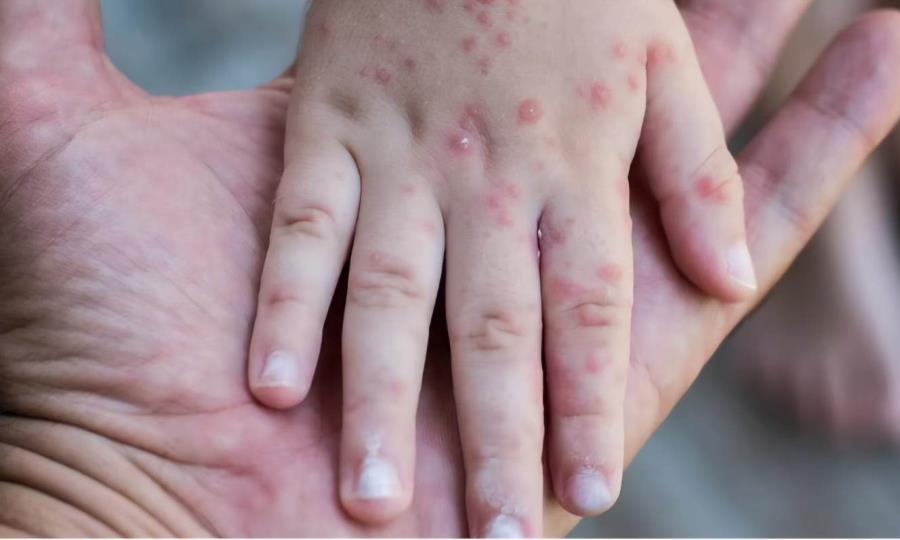 Virus Coxsackie afecta a guardería Smart Kids en Sabinas