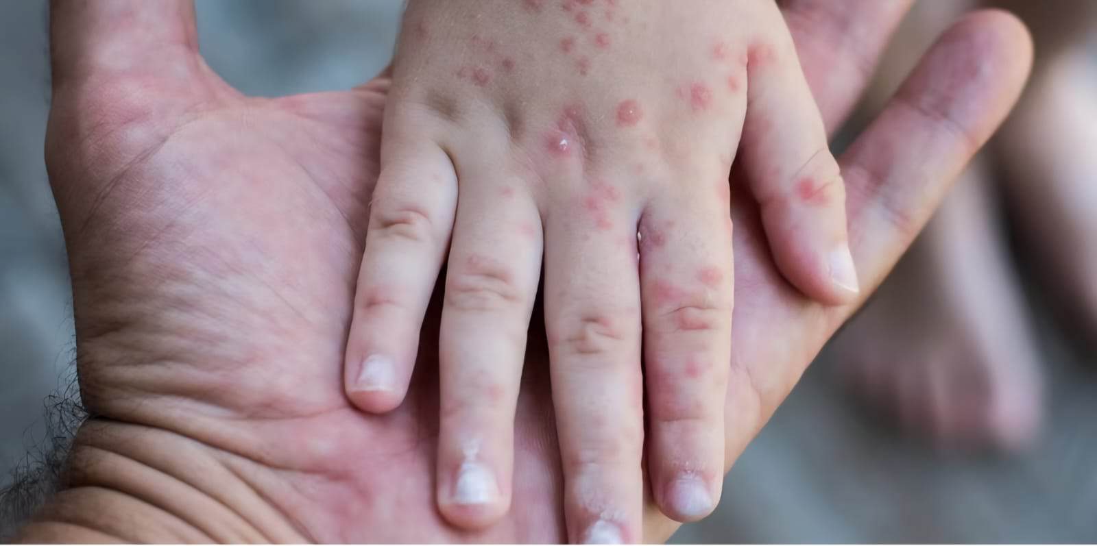 Virus Coxsackie afecta a guardería Smart Kids en Sabinas