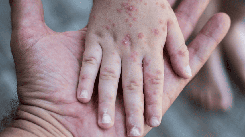 Descartan sarampión en Piedras Negras; detectan brotes leves de síndrome mano-pie-boca