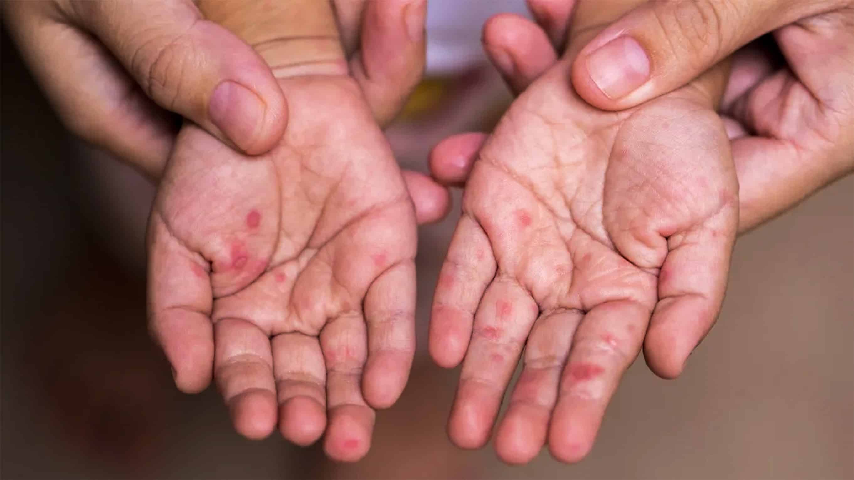 Cierran cinco salones escolares por brotes de virus de mano-pie-boca en Piedras Negras