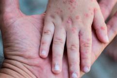 Detectan brotes de virus mano-pie-boca en escuelas de Piedras Negras