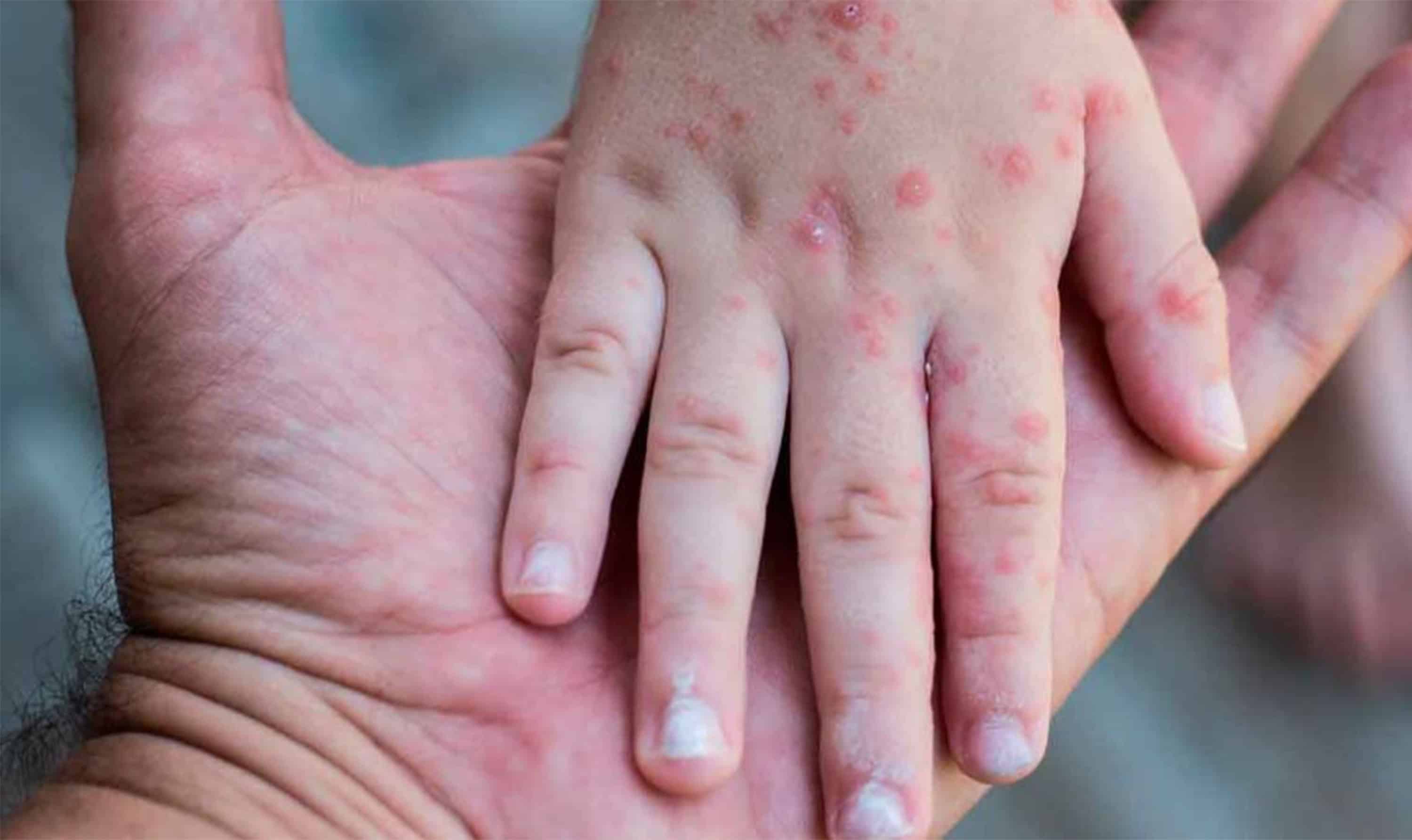 Detectan brotes de virus mano-pie-boca en escuelas de Piedras Negras