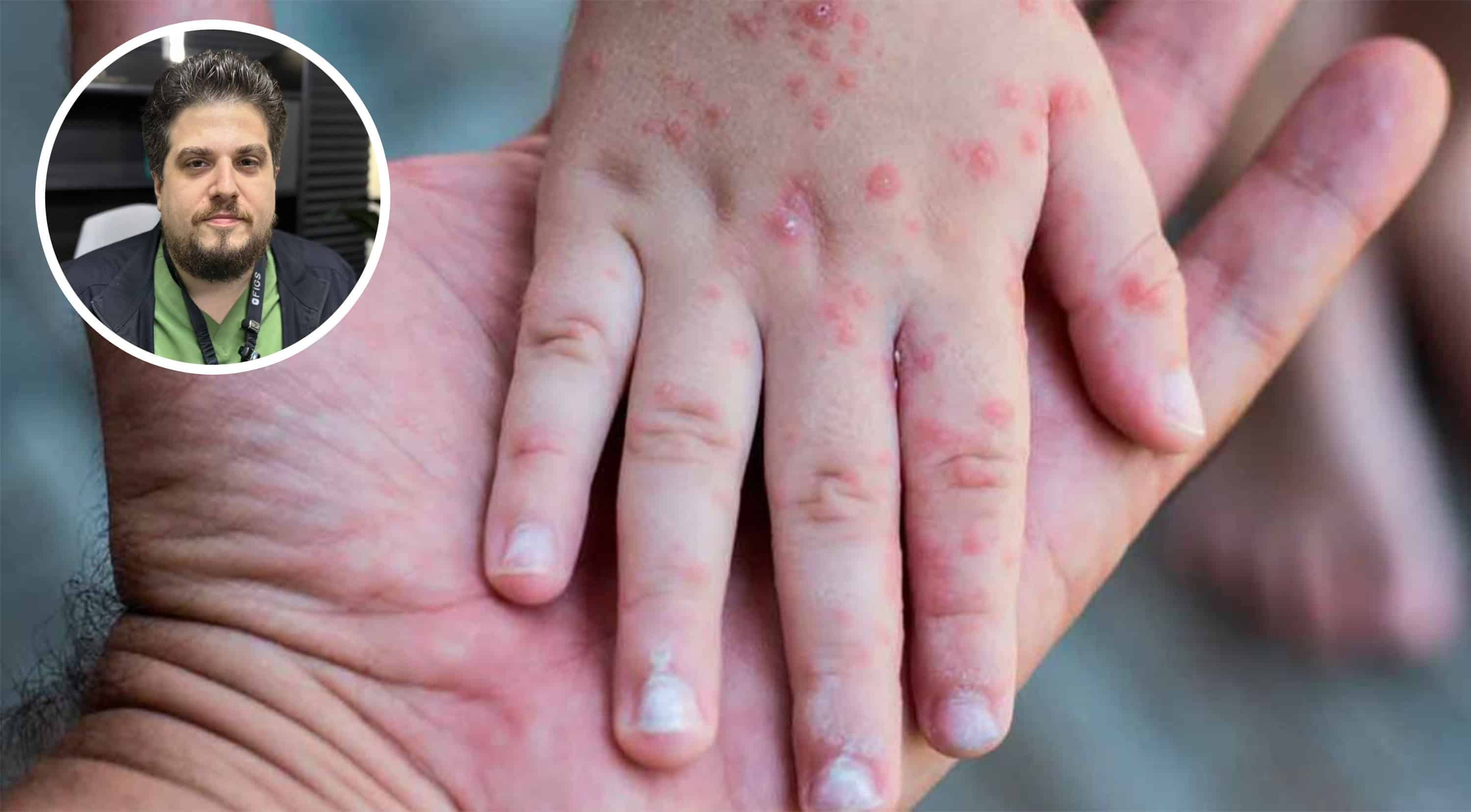 Detectan virus "mano, pie y boca" en escuelas de Piedras Negras, además de sospechosos de dengue y sarampión