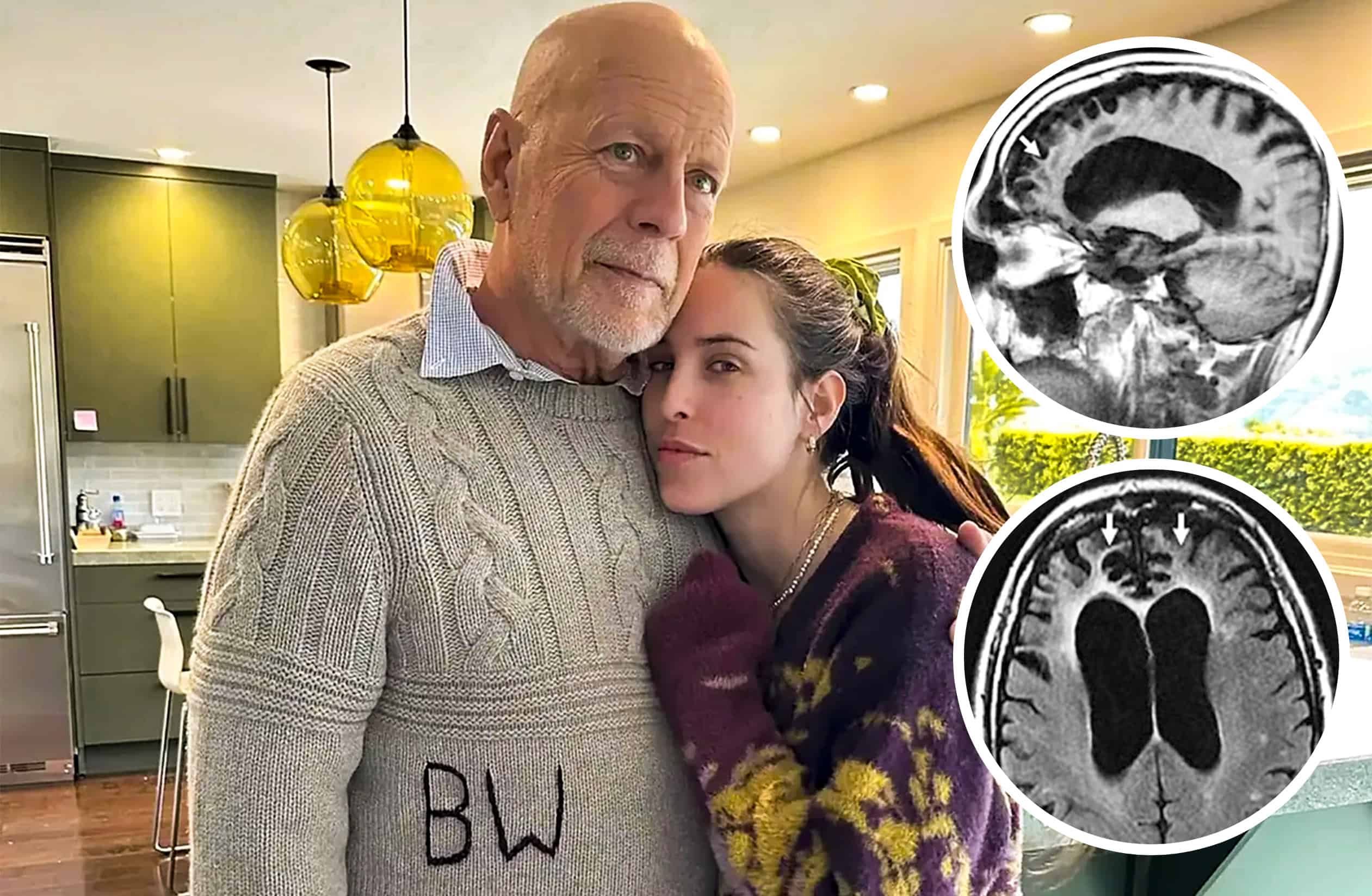 ¿La familia busca donar el cerebro de Bruce Willis? Aclaran rumores