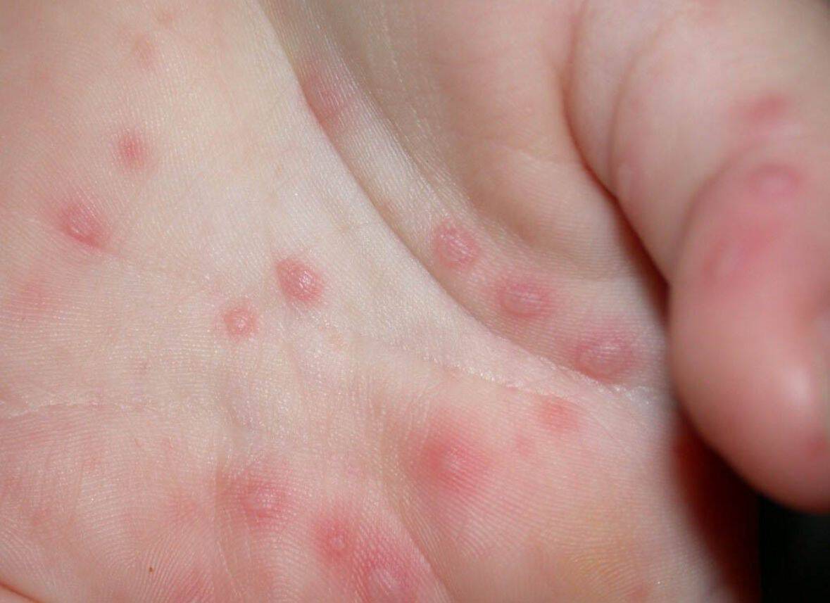 Cierran nueve salones por brotes de virus de mano-pie-boca en Piedras Negras