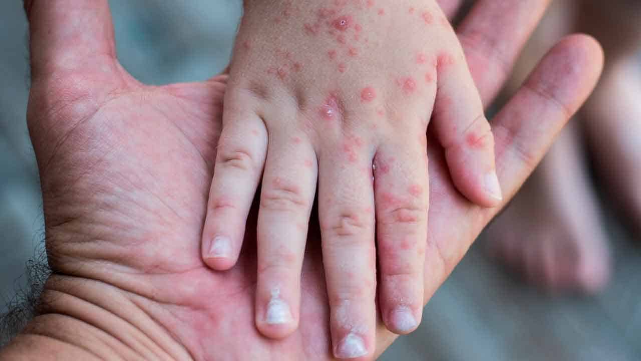 Bajan los contagios  de mano-pie-boca; cuatro salones continúan a distancia en Piedras Negras