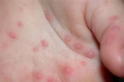 Disminuyen casos de virus Coxsackie en escuelas de Piedras Negras