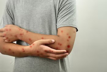 Brote de sarampi&oacute;n en M&eacute;xico: 9 mil casos y 28 defunciones