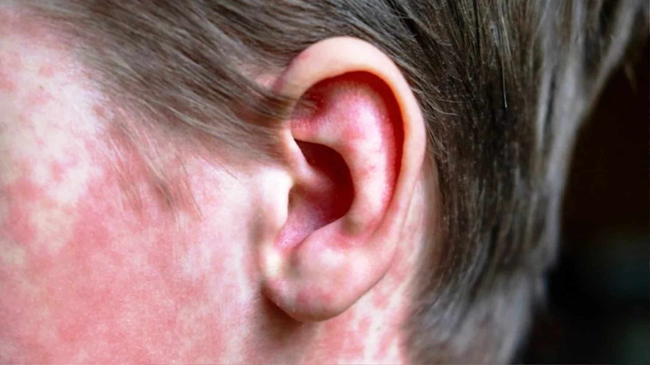 Acciones preventivas por sarampi&oacute;n en escuelas de Saltillo