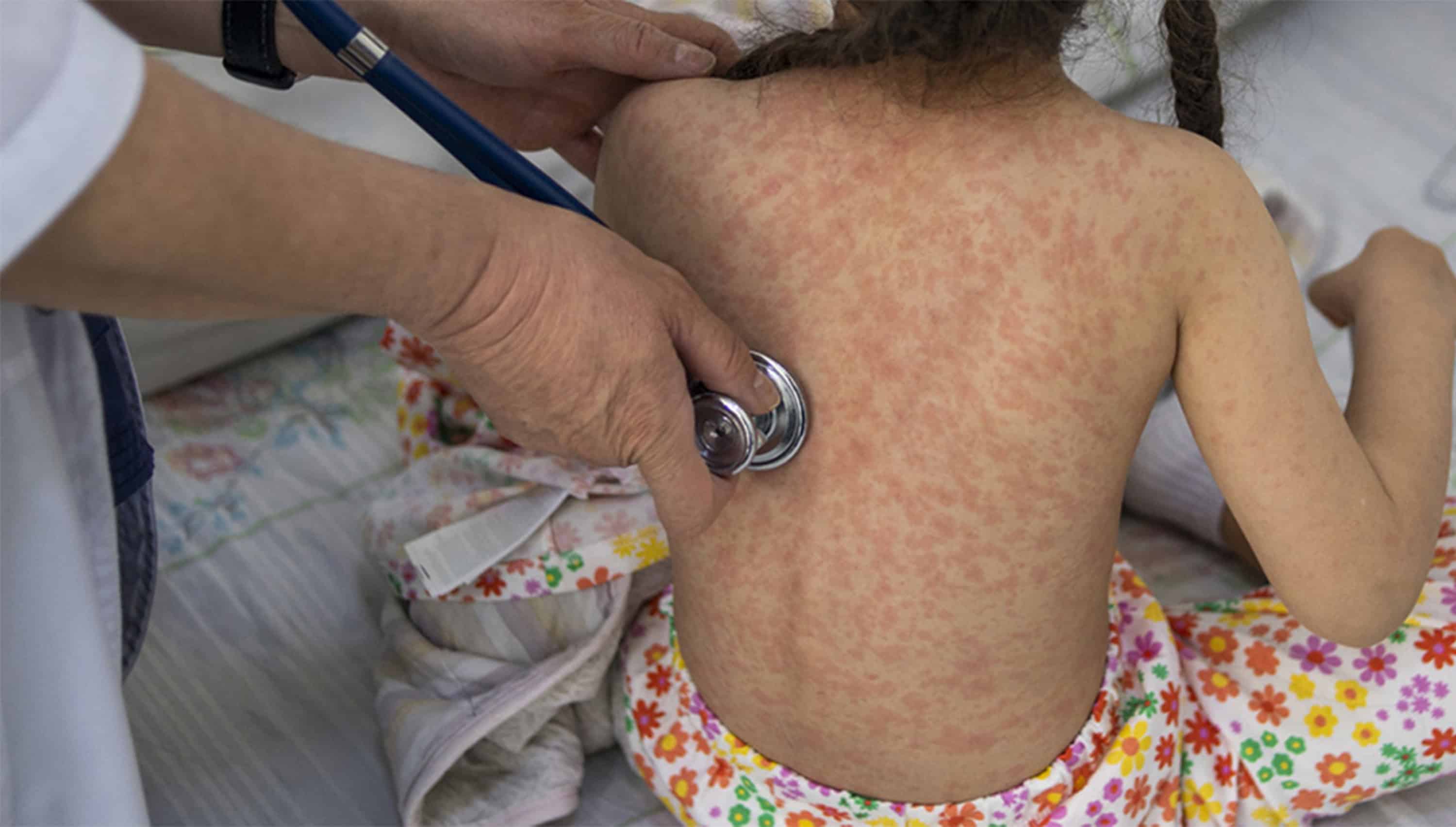 Secretar&iacute;a de Salud reporta 31 muertes por sarampi&oacute;n en M&eacute;xico