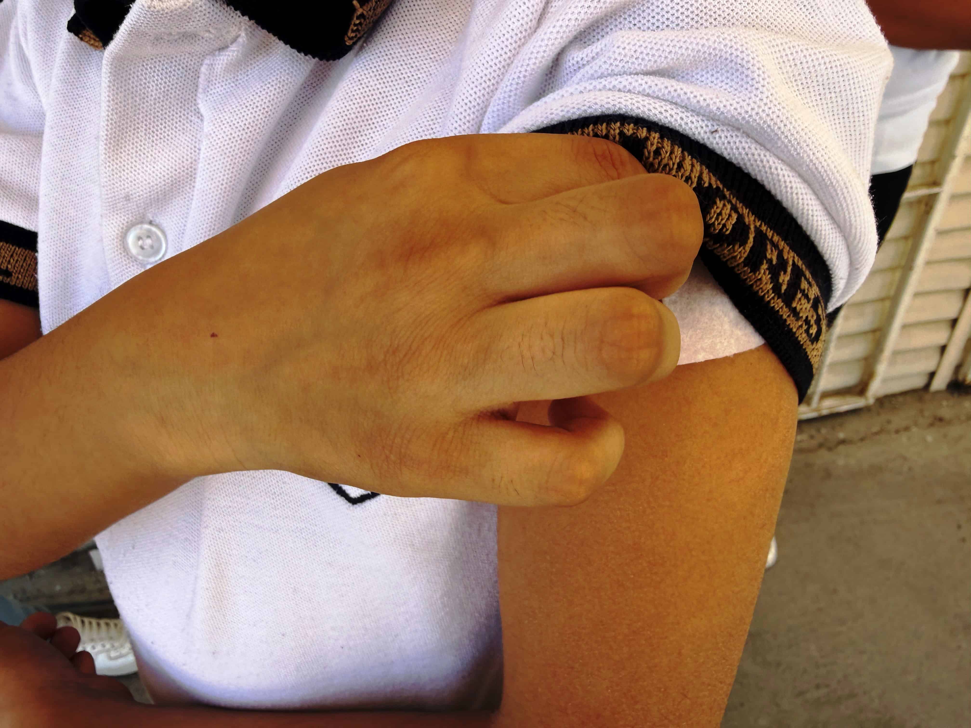 Alerta de sarampi&oacute;n en Escuela Primaria Mar&iacute;a Elena Flores Gaona